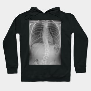 Scoliosis Xray Hoodie